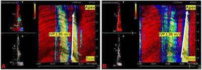Exploring the prospect of intrinsic wave propagation in evaluating myocardial stiffness among patients with type 2 diabetes